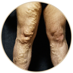 Endovenous Laser Treatment Orland Park IL